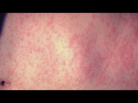 Measles case in Howard County linked to Dulles International Airport