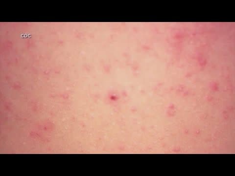 Texas DSHS reports increase in measles outbreak