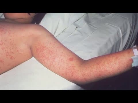 Measles cases in the US reach highest level since 2000