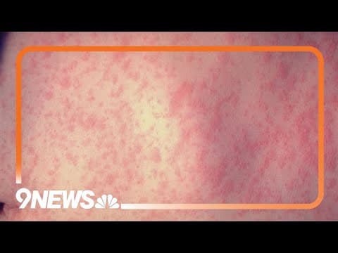 Colorado health officials: Check measles vaccine status ahead of spring break