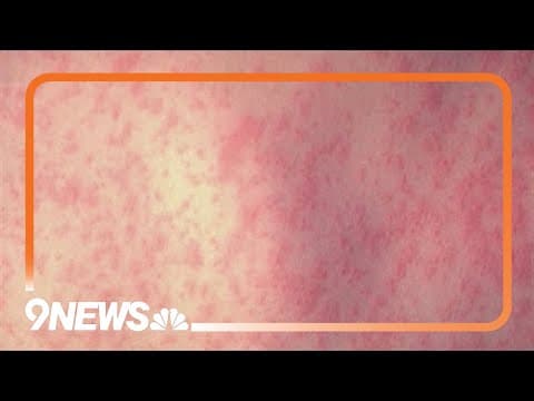 Second measles case confirmed in Denver