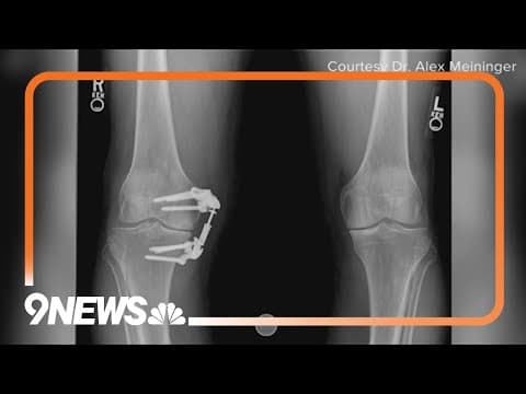 Doctor explains medical device that offers alternative to knee replacement