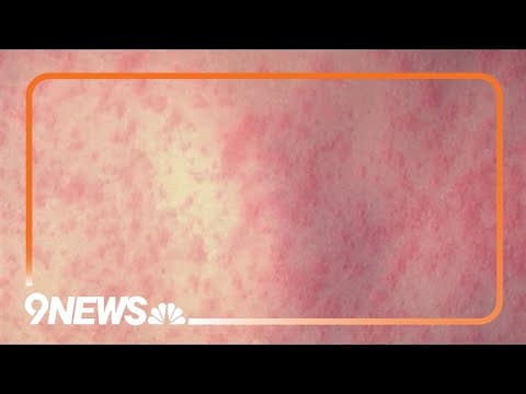 Measles cases reach record high in the US