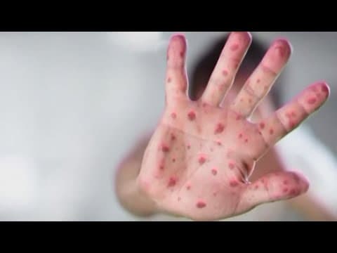 Child killed by measles complication years after being infected