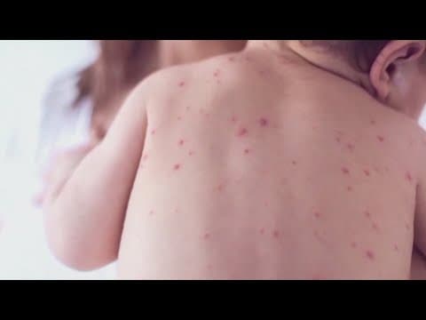 Measles outbreak grows nationwide; Knox County on high alert