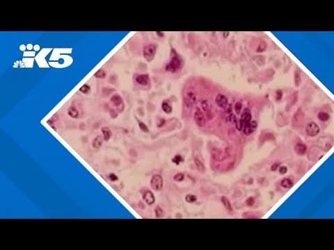 2 cases of measles exposure confirmed in Snohomish County